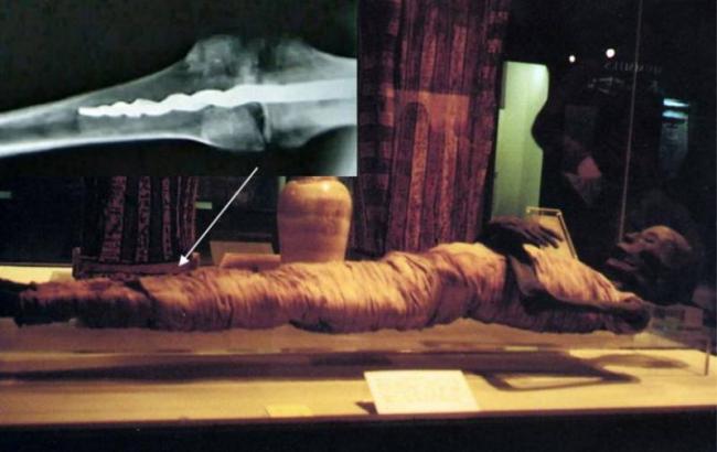 Медицинская загадка: штифт современного типа в ноге мумии