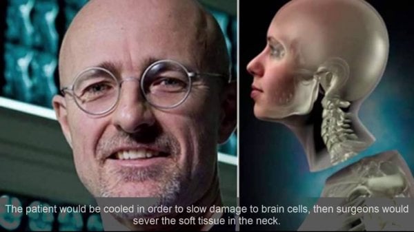 В 2020 году ученый Канаверо пересадит человеку голову