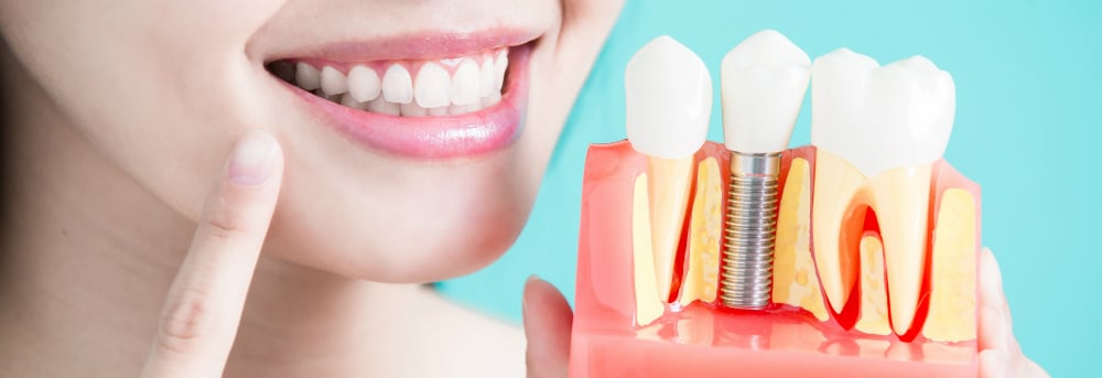 Имплантация зубов – идеальный способ восстановить свое здоровье